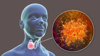 થાયરોઇડના દર્દીઓએ ખાનપાનમાં કઇ બાબતનું ધ્યાન રાખવું જોઇએ ? જાણો તમામ માહિતી