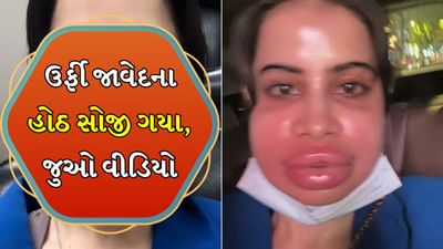 Urfi Javed એ હટાવ્યા લિપ ફિલર, લીધા પીડાદાયક ઇન્જેક્શન ! સોજો આવેલા હોઠ અને વિકૃત ચહેરો, કહ્યું- 18 વર્ષની ઉંમરથી...