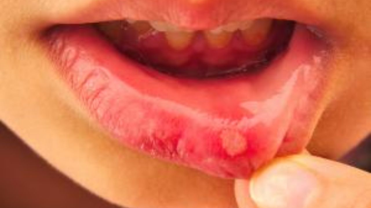 મોઢામાં ચાંદા પડવા એ એક સામાન્ય સમસ્યા છે પરંતુ જ્યારે તે વારંવાર થાય છે, ત્યારે તે ચિંતાનો વિષય બની શકે છે. સંશોધન મુજબ લગભગ 20% લોકો વારંવાર મોઢામાં ચાંદા પડવાની સમસ્યાથી પીડાય છે, જે ઘણીવાર એસિડિટી, વિટામિન B12 અથવા આયર્નની ઉણપ, નબળી રોગપ્રતિકારક શક્તિ અથવા પાચન વિકૃતિઓ સાથે સંકળાયેલી હોય છે. વારંવાર ચાંદા પડવા એ ફક્ત ખોરાકની ખામી જ નહીં પરંતુ શરીરમાં આંતરિક વિક્ષેપનું સંકેત પણ હોઈ શકે છે. મોઢામાં ચાંદા પડવાની સમસ્યાને સમયસર ઓળખવી અને તેની સારવાર કરવી મહત્વપૂર્ણ છે.
