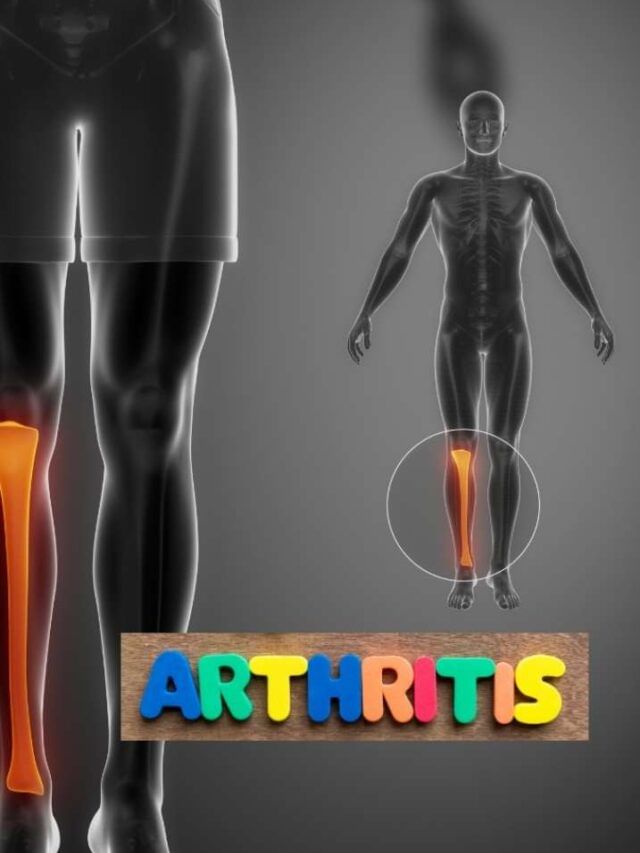 Arthritis ના દર્દીઓએ શું ન ખાવું જોઈએ? Arthritis ના દર્દીઓએ શું ન ખાવું જોઈએ?