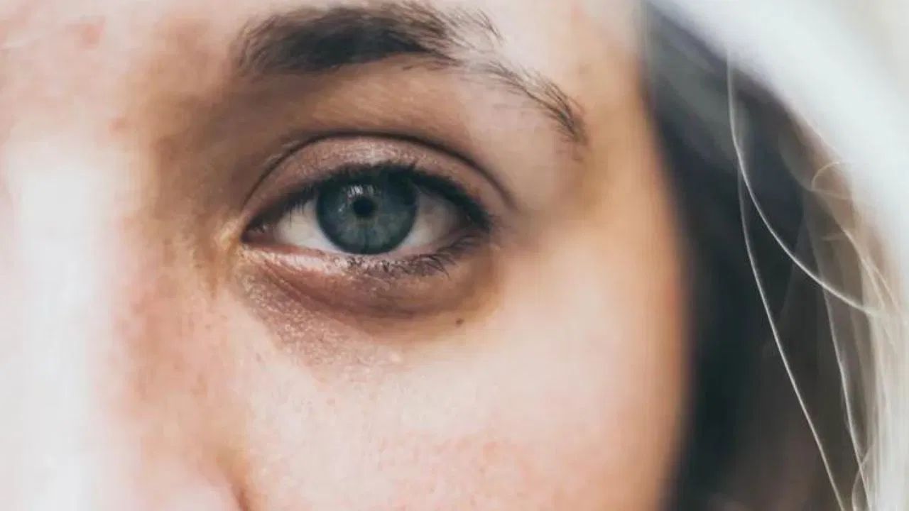 ડાર્ક સર્કલ થવાના કારણો - ડાર્ક સર્કલ થવા અંગે ડૉક્ટરનું કહેવું છે કે, 'આંખોની નીચે ખૂબ જ નાનો એક ફેટ પોકેટ (સોફ્ટ જેન્ટલ ફેટ પાર્ટ) હોય છે, જે આનુવંશિક રીતે ઉંમર વધવાની સાથે સૌથી પહેલા ગાયબ થાય છે અને 14-15 વર્ષની ઉંમરે પણ આ પોકેટ ગાયબ થઈ જાય છે. આ જ કારણથી આંખોની નીચે ડાર્ક સર્કલ થવા લાગે છે. જેમ કે, ઊંઘનો અભાવ, ખાવામાં બેદરકારી, તણાવ, વૃદ્ધત્વ, ડિહાઇડ્રેશન અથવા સ્ક્રીન પર વધુ સમય વિતાવવાથી પણ ડાર્ક સર્કલ આવે છે. ડાર્ક સર્કલ દૂર કરવાના ઉપાય જાણો.