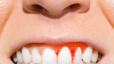 મીઠાવાળા પાણીના કોગળા કરો: એક ગ્લાસ હુંફાળા પાણીમાં અડધી ચમચી મીઠું નાખીને દિવસમાં બે-ત્રણ વાર કોગળા કરવાથી પેઢાનો સોજો ઓછો થાય છે અને બ્લીડિંગ અટકાવવામાં મદદ મળે છે.