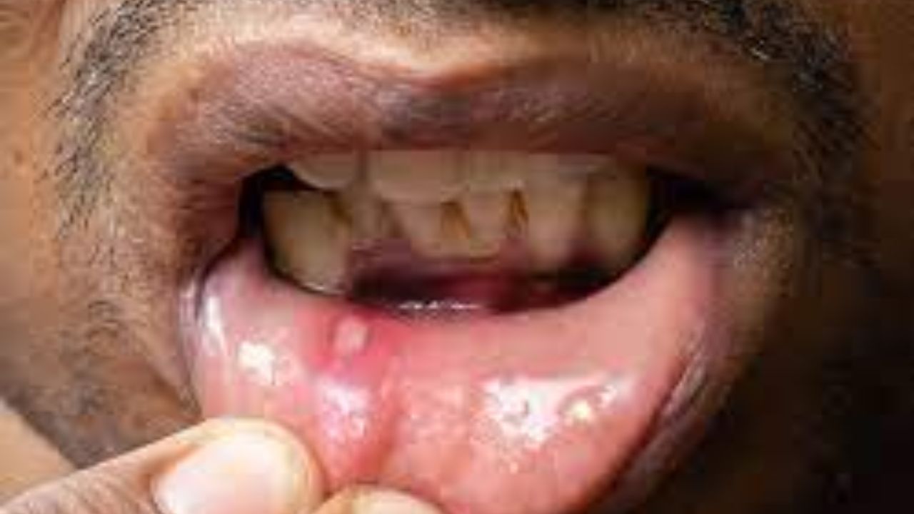 નબળી રોગપ્રતિકારક શક્તિ : એઈમ્સના ગેસ્ટ્રોએન્ટેરોલોજી વિભાગના ભૂતપૂર્વ ડૉ. અનન્યા ગુપ્તા સમજાવે છે કે જો તમારા શરીરની રોગપ્રતિકારક શક્તિ એટલે કે રોગપ્રતિકારક શક્તિ નબળી હોય, તો તે વારંવાર અલ્સર થવાનું મુખ્ય કારણ બની શકે છે. કેટલાક સ્વયંપ્રતિરક્ષા રોગો, જેમ કે લ્યુપસ અથવા બેહસેટ સિન્ડ્રોમ, જે એક દુર્લભ પરંતુ ગંભીર સ્વયંપ્રતિરક્ષા અને બળતરા રોગ છે જે શરીરની રક્ત વાહિનીઓમાં બળતરાનું કારણ બને છે. આ રોગ શરીરના ઘણા ભાગોને એકસાથે અસર કરી શકે છે - જેમ કે મોં, આંખો, ત્વચા, ગુપ્તાંગ, સાંધા અને ક્યારેક મગજ અને પાચન તંત્ર પણ. સ્વયંપ્રતિરક્ષા રોગો વારંવાર મોંમાં ચાંદા અથવા અલ્સરનું કારણ બની શકે છે. આ ઉપરાંત સતત થાક, નબળાઇ અથવા વારંવાર બીમાર પડવું પણ આ વિકૃતિના સંકેતો હોઈ શકે છે.
