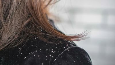 ચોમાસાની ઋતુ શરૂ થતાં જ ઠંડી પવન, હળવો વરસાદ અને માટીની સુગંધ બધાને મોહિત કરે છે. પરંતુ આ સુખદ હવામાનમાં, કેટલીક આવી સમસ્યાઓ પણ આપણી આસપાસ શાંતિથી વધવા લાગે છે, જેની આપણે કલ્પના પણ નથી કરતા. ત્વચાની એલર્જી, વાળ ખરવા, માથાનો દુખાવો જેવી સમસ્યાઓની સાથે, બીજી એક સામાન્ય પણ ખૂબ જ પરેશાન કરતી સમસ્યા છે ખોડો (ડેન્ડ્રફ).