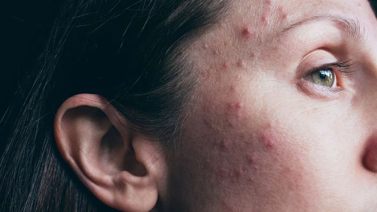 ઘરગથ્થુ ઉપચાર- દૂધ અને મધ મિક્સ કરીને તેને ડાઘ પર 10 થી 15 મિનિટ સુધી લગાવો અને પછી તેને ધોઈ લો. કાકડી અને દહીંની પેસ્ટ બનાવો અને તેને 30-40 મિનિટ સુધી ત્વચા પર લગાવો અને પછી તેને ધોઈ લો. પપૈયાની પેસ્ટ બનાવો અને તેને ડાઘ પર લગાવો અને પછી તે સુકાઈ જાય પછી તેને ધોઈ લો. ડૉક્ટરની સલાહ લો.