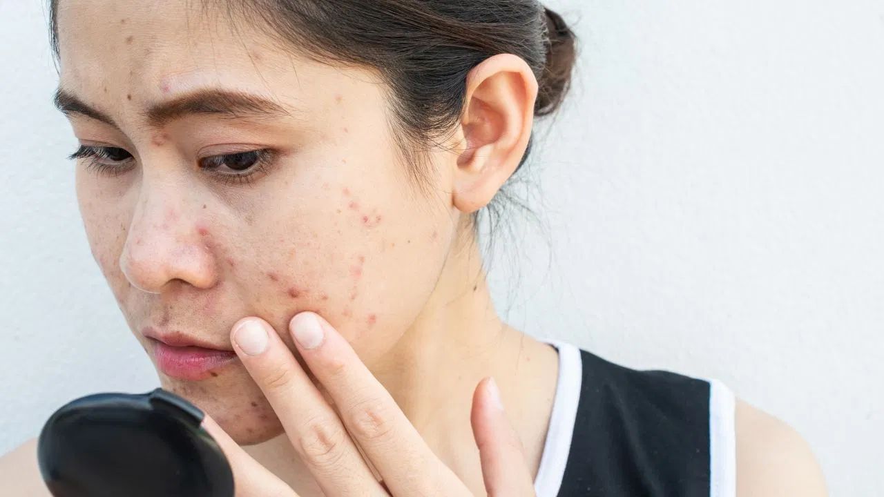 કેવી રીતે અટકાવવું? - વધુ પડતા સૂર્યપ્રકાશમાં બહાર જવાનું ટાળો. જો જરૂરી હોય તો, સનસ્ક્રીન લગાવ્યા પછી જ બહાર જાઓ. આ સિવાય, ટોપી, સ્કાર્ફ, છત્રી અથવા ચશ્મા પહેરો.
ત્વચાનું ધ્યાન રાખો - હળવા સાબુ અથવા ફેસવોશનો ઉપયોગ કરવો વધુ સારું રહેશે. રાસાયણિક મેકઅપ અથવા સ્ક્રીન પ્રોડક્ટ્સનો ઉપયોગ કરવાનું ટાળો. ત્વચા પર મોઇશ્ચરાઇઝર લગાવો.