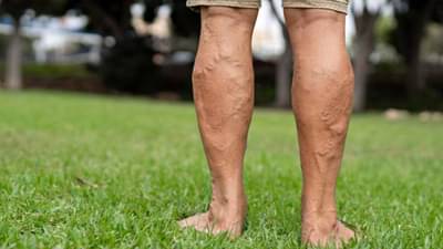 Varicose veins : ટાઈટ જીન્સ પહેરવાથી થઈ શકે છે નસોની આ ખતરનાક બીમારી, જાણો સમસ્યાનો ઉપાય