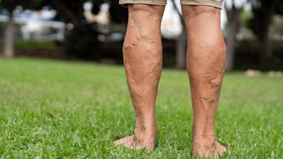 Varicose veins : ટાઈટ જીન્સ પહેરવાથી થઈ શકે છે નસોની આ ખતરનાક બીમારી, જાણો સમસ્યાનો ઉપાય
