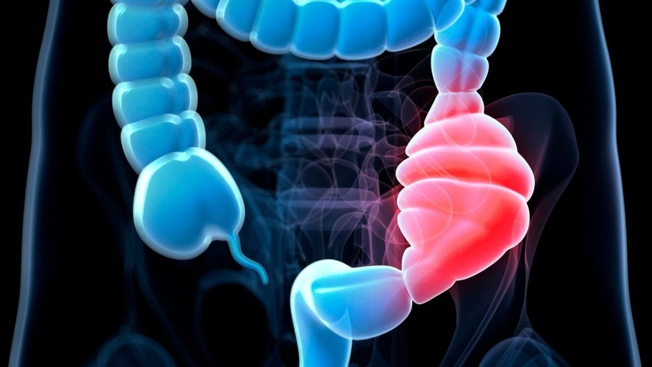 જંક ફૂડ, મસાલેદાર ખોરાક, મોડે સુધી સૂવું, ઓછું પાણી પીવું અને તણાવ આ સમસ્યાઓમાં વધારો કરે છે. આયુર્વેદ અનુસાર, અસંતુલિત પિત્ત અને વાત દોષ આનું મુખ્ય કારણ છે. વૃદ્ધો, સગર્ભા સ્ત્રીઓ, ફાસ્ટ ફૂડ ખાતા લોકો અને બેઠા બેઠા કામ કરતા લોકો વધુ જોખમમાં હોય છે.