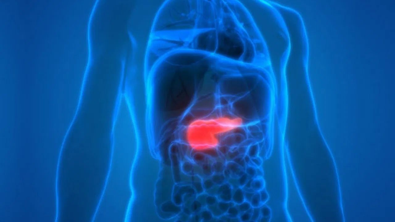 સ્વાદુપિંડનો સોજો - સ્વાદુપિંડની બળતરા દરમિયાન, કેલ્શિયમ ચરબી સાથે જોડાય છે અને તેના લક્ષણોમાં પેટના ઉપરના ભાગમાં તીવ્ર દુખાવો, ઉબકા, ઉલટી, તાવ અને પાચન સમસ્યાઓનો સમાવેશ થાય છે.