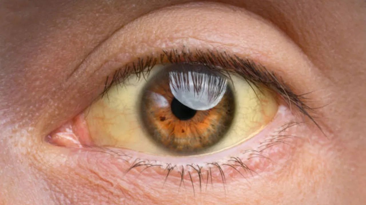 જો આંખો વારંવાર લાલ દેખાય છે તો સમજી જજો કે, આ કિડની સંબંધિત સમસ્યાનું સંકેત હોઈ શકે છે. આનું કારણ હાઈ બ્લડ પ્રેશર અથવા ડાયાબિટીસ હોઈ શકે છે. ક્યારેક લ્યુપસ નેફ્રાઇટિસ જેવા કિડનીના રોગો પણ આંખોને અસર કરે છે.