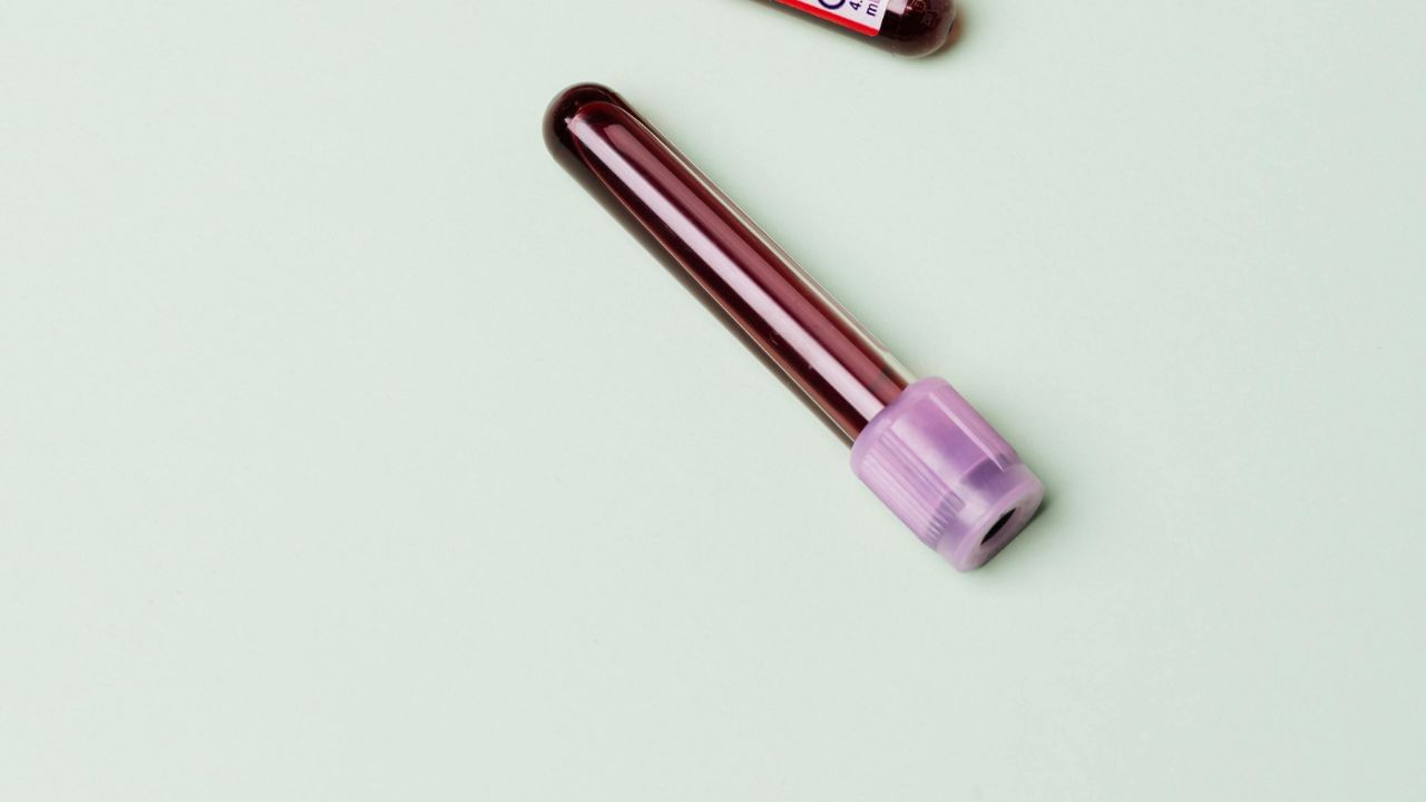 શીરરમાં હિમોગ્લોબિનની ઉણપ કોઈ બીમારીથી શરીરમાં લોહીની ઉણપ હોવાનું પરિણામ છે. ખાસ કરીને જે મહિલાઓને હેવી પીરિયડ્સ આવે છે. તેનામાં પણ હિમોગ્લોબિનની ઉણપ આવે છે.