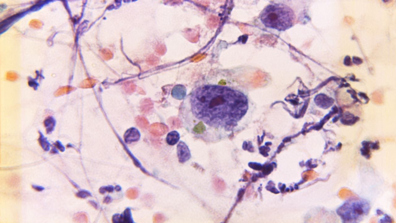 જો આમ છતાં શરીરમાં કોઈ પ્રકારના સંકેત જોવા મળે છે કે, સતત થાક લાગવો, કમર કે પીઠમાં દુખાવો, શારીરિક સંબંધ બાંધ્યા બાદ બ્લીડિંગ કે દુર્ગંધ આવે કે, ડિસ્ચાર્જ થાય તો તરત જ ટેસ્ટ કરાવો. સમયસર ટેસ્ટ કરવાથી કેન્સર જેવી બીમારીઓથી બચી શકાય છે.