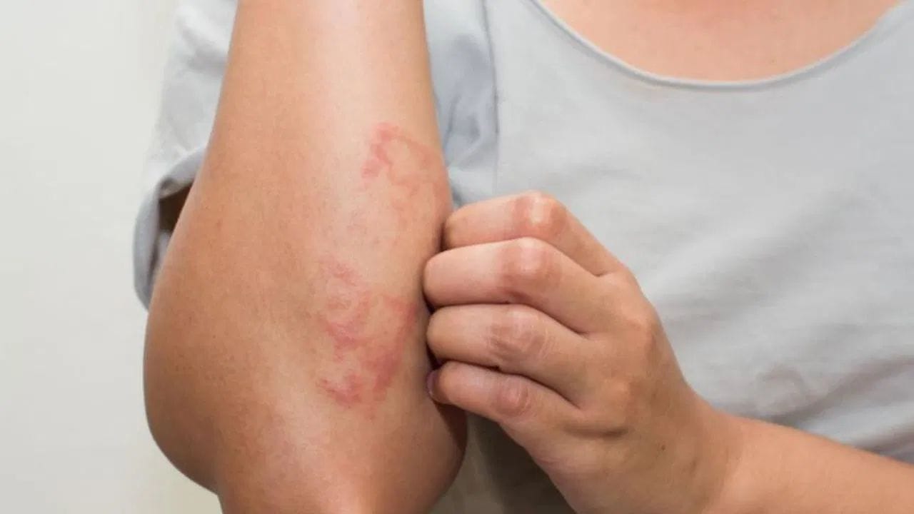 ખરજવું - ખરજવું એ ત્વચાની સમસ્યા છે, જેમાં ત્વચા પર ખંજવાળ અને લાલાશ થાય છે. વિટામિન D રોગપ્રતિકારક શક્તિને નિયંત્રિત કરવામાં મદદ કરે છે અને તેની ઉણપ ત્વચાની બળતરા વધારી શકે છે, જે ખરજવાના લક્ષણોને વધુ ગંભીર બનાવે છે.