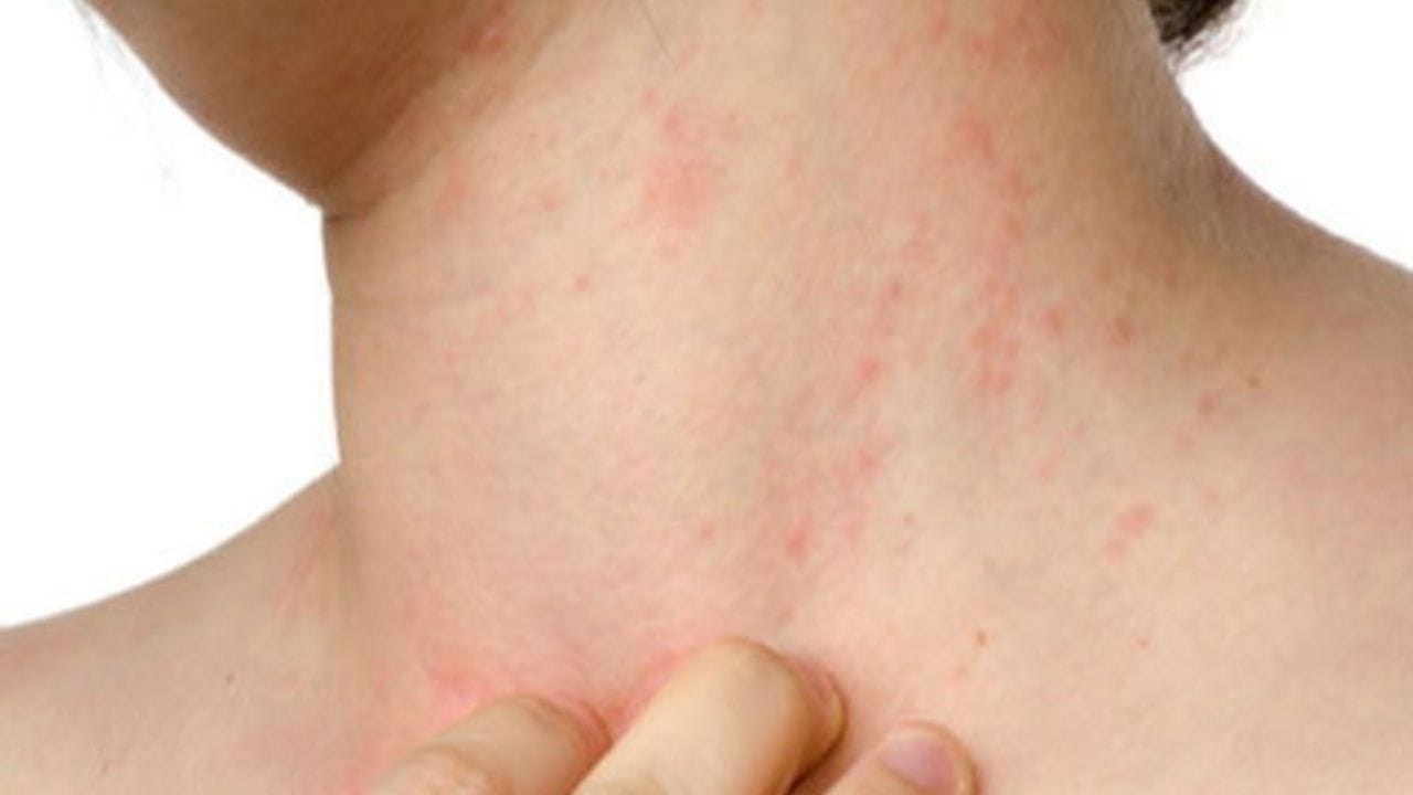 ત્વચા સમસ્યાઓ - ડિઓડોરન્ટમાં રહેલા રસાયણો કેટલાક લોકોમાં ત્વચા શુષ્કતા અને એલર્જીનું કારણ બની શકે છે. આનાથી ખંજવાળ, બળતરા અને લાલાશ જેવી ત્વચાની સમસ્યાઓ થઈ શકે છે.