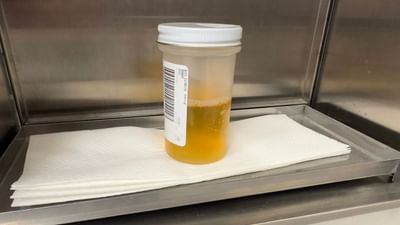 પેશાબનો રંગ આપણા સ્વાસ્થ્યનો સંકેત આપે છે. સામાન્ય સ્થિતિમાં, તેનો રંગ આછો પીળો અથવા સફેદ જોવા મળે છે. પરંતુ જો તેમાં સતત ફેરફાર થતો રહે તો તે ખતરનાક બની શકે છે. ક્યારેક પેશાબનો ઘટ્ટ પીળો કલર, ભૂરો અથવા લાલ રંગ પિત્તાશયમાં પથરીની સમસ્યા દર્શાવે છે. પિત્તાશયમાં પથરીની સમસ્યા એક ગંભીર સમસ્યા છે, જે ધીમે ધીમે શરીરને અસર કરે છે અને જો સમયસર સારવાર ન કરવામાં આવે તો તે મોટી સમસ્યાઓનું કારણ બની શકે છે.