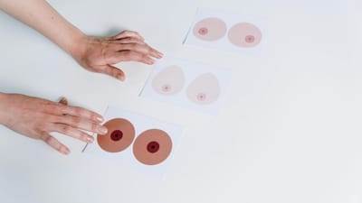 નિપ્પલ ડિસ્ચાર્જનો અર્થ એ થાય છે કે, એક કે, બંન્ને નિપ્પલમાં ખાસ પ્રકારનું ફલ્લૂડ ડિસ્ચાર્જ થવું. સામાન્ય રીતે પ્રેગ્નન્સીના છેલ્લા દિવસોમાં અથવા ડિલિવરી પછી તરત જ સ્તનમાંથી સ્રાવ શરૂ થાય છે. આ સંપૂર્ણપણે સામાન્ય છે. તે કોઈપણ પ્રકારના રોગ સાથે સંકળાયેલ નથી.