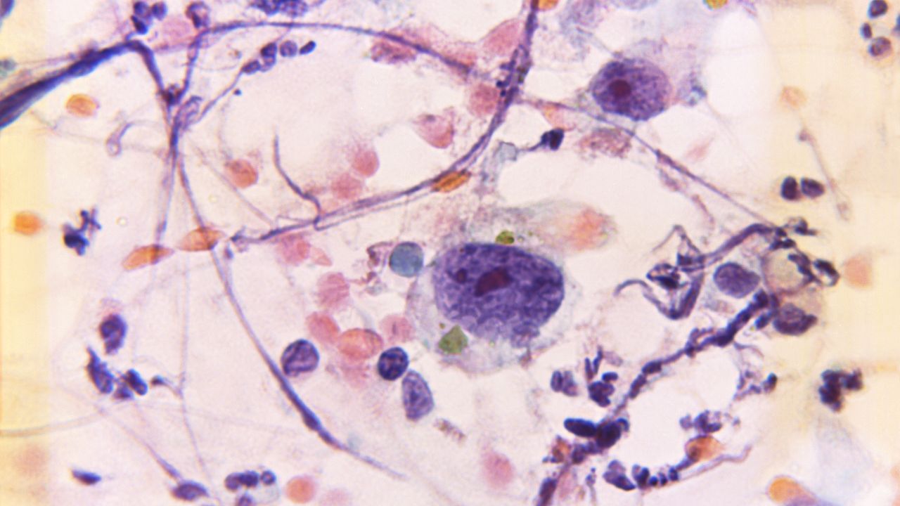 જેમ જેમ કેન્સર વધે છે, પેટમાં પ્રવાહી એકઠું થવા લાગે છે, જેના પરિણામે પેટમાં દુખાવો,થાક લાગે છે.ઉલટી અથવા ઉબકા આવા લાગે તેમજ શ્વાસ લેવામાં તકલીફ થાય છે.