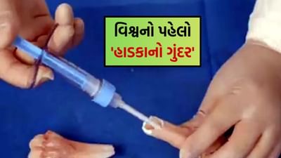 વૈજ્ઞાનિકોએ બનાવ્યો વિશ્વનો પહેલો 'હાડકાનો ગુંદર', મિનિટોમાં તૂટેલા હાડકાં જોડશે