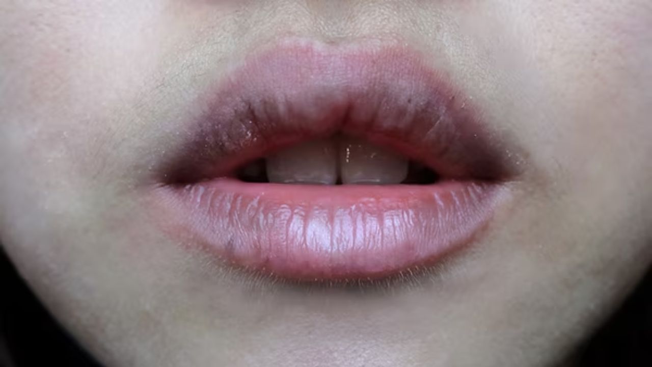 ઓછું પાણી પીવાની આદત: શરીરને સ્વસ્થ રાખવાની સાથે ત્વચાને સ્વસ્થ રાખવા માટે એ પણ જરૂરી છે કે તમે પુષ્કળ પાણી પીતા રહો. પાણીની અછતને કારણે હોઠની ત્વચા વધુ શુષ્ક થઈ શકે છે અને તેના કારણે કાળાશ પણ વધવા લાગે છે. જો તમે ઓછું પાણી પીઓ છો, તો તેનું સેવન વધારવાનો પ્રયાસ કરો.
