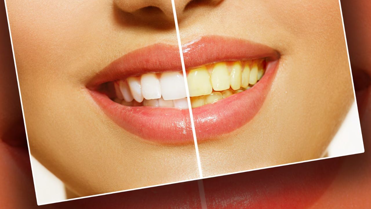 क्या आप अपने दांतों को अच्छी तरह ब्रश करते हैं, लेकिन फिर भी आपके दांत पीले पड़ गए हैं? अगर ऐसा है, तो यह दंत समस्या विटामिन डी की कमी का संकेत हो सकती है।