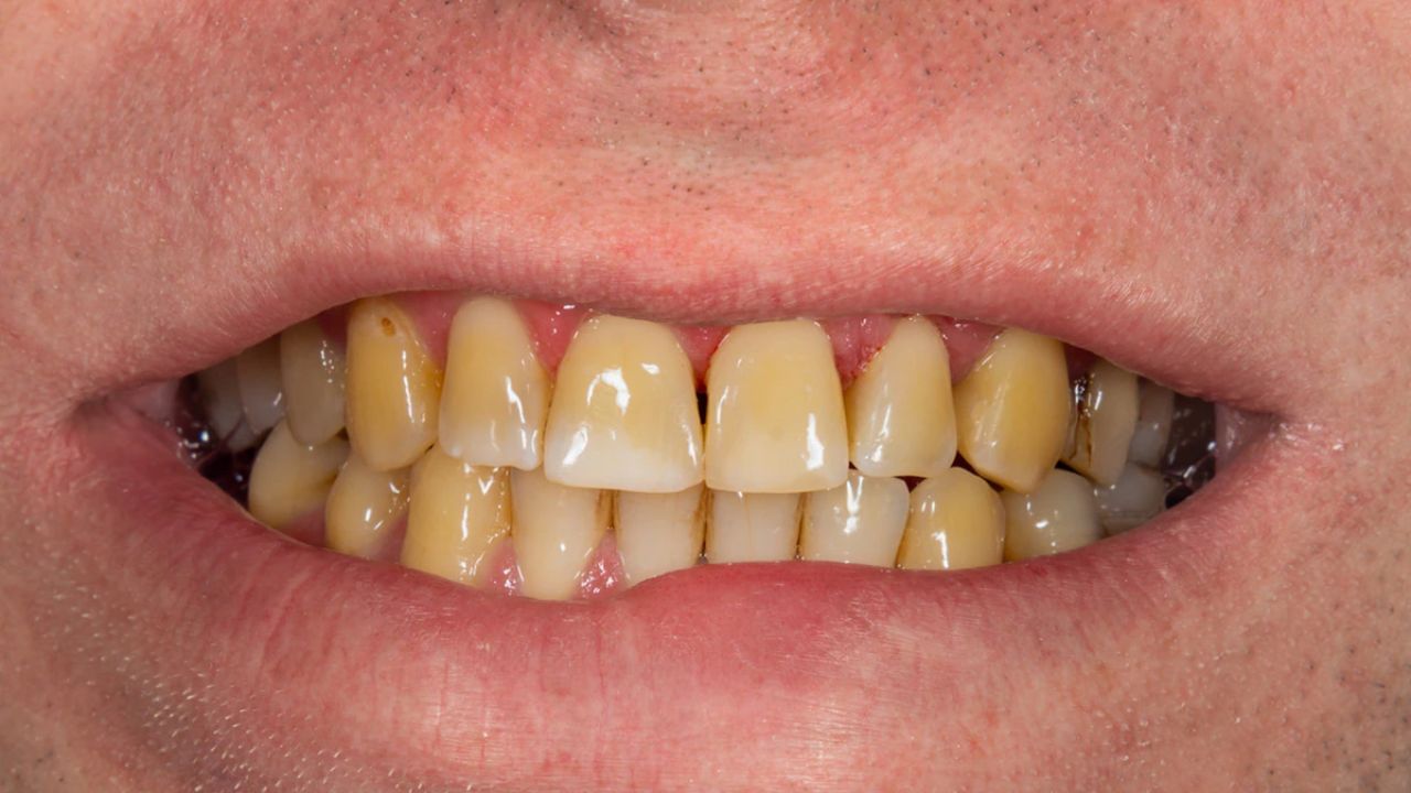 आइए इसके पीछे का कारण समझने की कोशिश करते हैं। विटामिन डी की कमी से इनेमल कमज़ोर हो जाता है। इससे इनेमल के नीचे पीला डेंटिन ज़्यादा दिखाई देने लगता है और दांत पीले दिखाई देने लगते हैं।