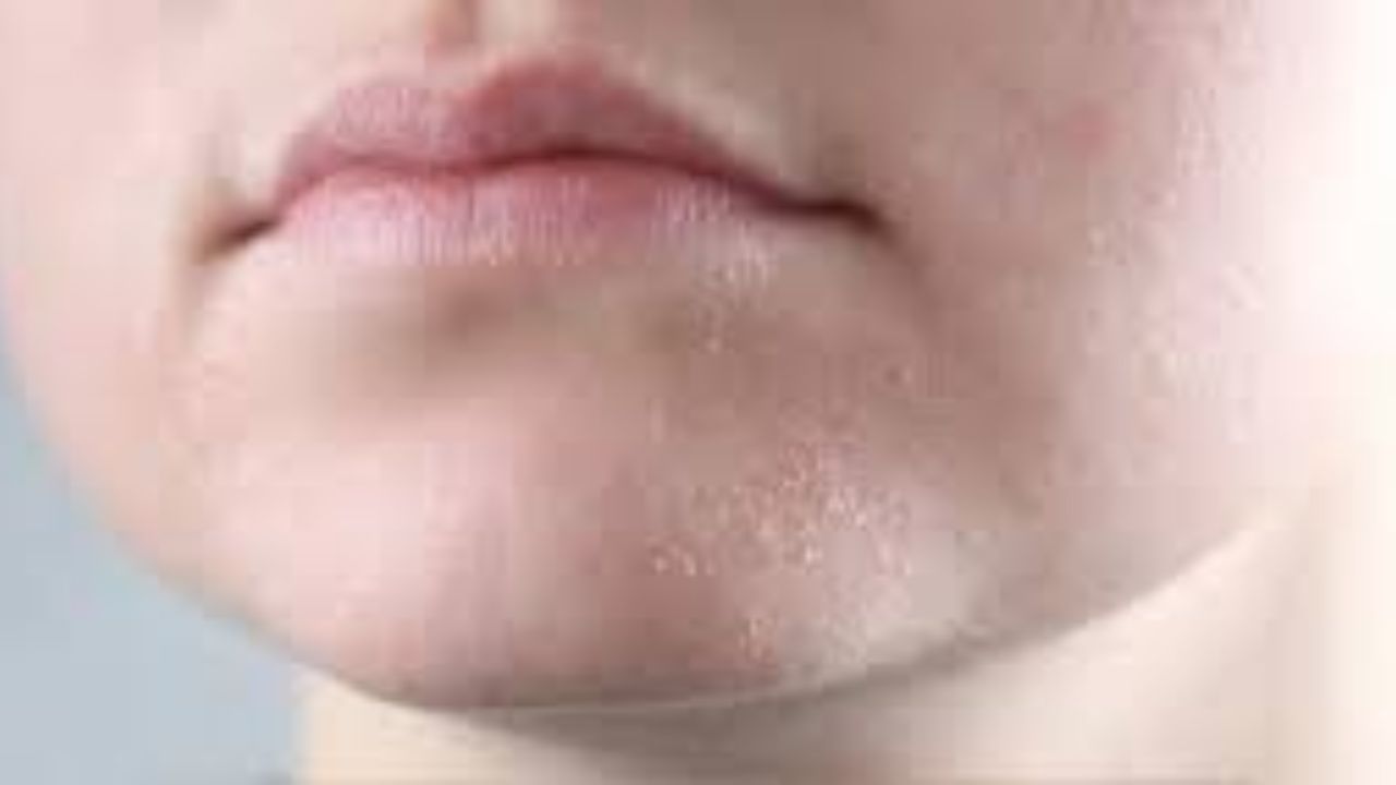 આ એવી સ્થિતિ છે, જેમાં ત્વચા પર સફેદ પોપડી બને છે, ખોડો થવા લાગે છે અને ત્વચા ફાટવા લાગે છે. આના ઘણા કારણો હોઈ શકે છે, જેમાંથી એક હાર્ડ બોડી વોશ, ફેસ વોશ અથવા સાબુનો ઉપયોગ છે. શિયાળામાં ફક્ત ચહેરો જ નહીં પરંતુ આખા શરીરની ત્વચા શુષ્ક થઈ જાય છે, તેથી આનાથી છુટકારો મેળવવા માટે કેટલીક નાની બાબતો ધ્યાનમાં રાખવી જોઈએ.