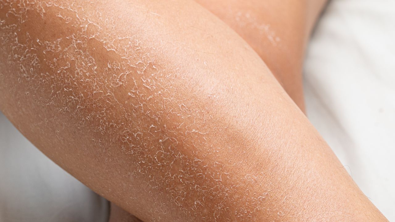 તમારી ત્વચાને સ્ક્રબ કરવાનું ટાળો: નહાતી વખતે તમારી ત્વચાને વધુ પડતું સ્ક્રબ કરવાનું ટાળો અને વધુ પડતું સ્ક્રબ વાપરવાનું ટાળો. જો ખંજવાળ આવે છે, તો મોઇશ્ચરાઇઝર લગાવો; ખંજવાળથી ફોલ્લીઓ થઈ શકે છે. આ ઉપરાંત નરમ ટુવાલનો ઉપયોગ કરો. બીજા કોઈના કપડાં અથવા ટુવાલનો ઉપયોગ કરશો નહીં.