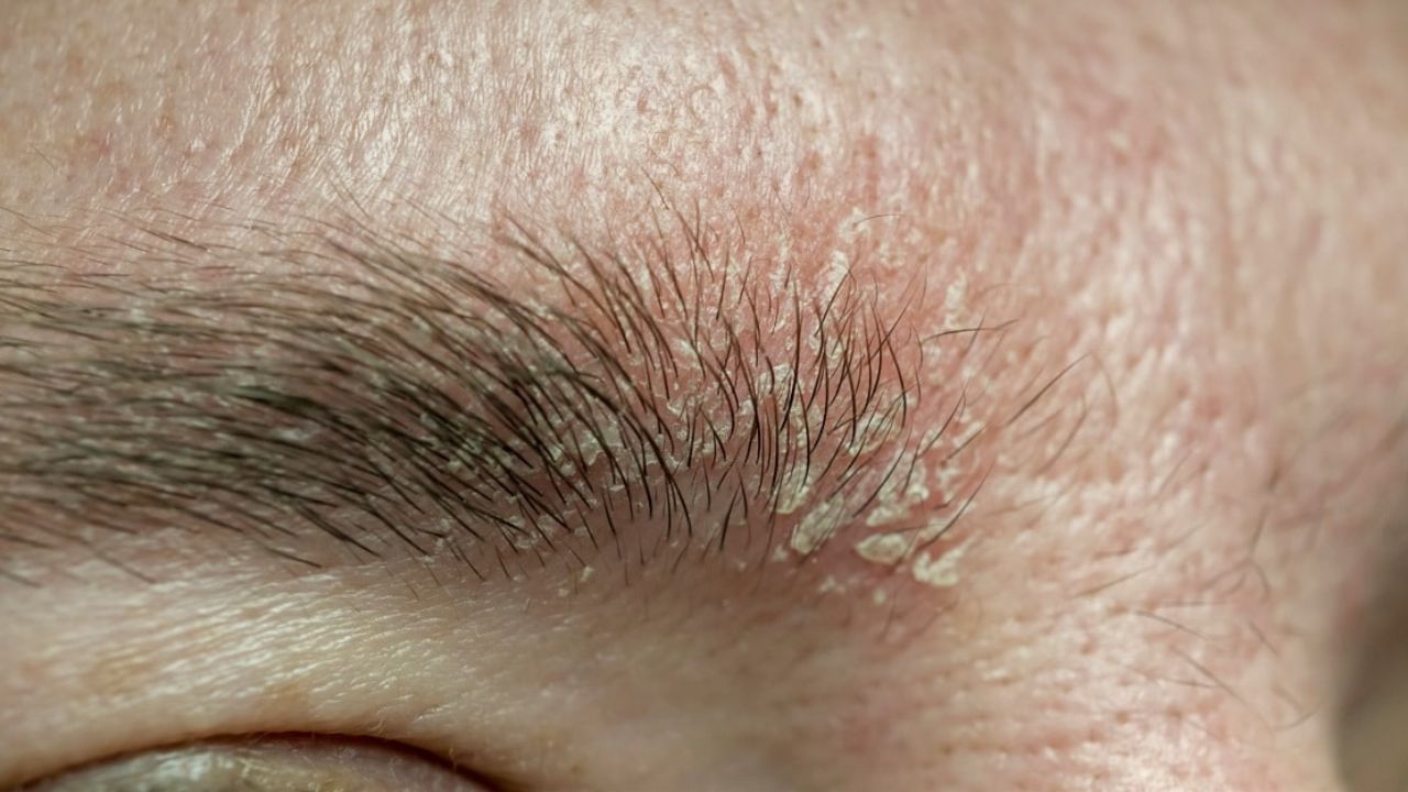 સાઇટ્રસ ફળોને તમારા આહારનો ભાગ બનાવો: મોટાભાગના લોકો માને છે કે શિયાળામાં સાઇટ્રસ ફળો ખાવાથી ખાંસી થશે, પરંતુ આવું નથી. તમે તમારા આહારમાં નારંગી અને લીંબુનો સમાવેશ કરી શકો છો. કારણ કે તે વિટામિન સીનો સ્ત્રોત છે અને સ્વસ્થ ત્વચા જાળવવામાં મદદ કરે છે. જામફળ વિટામિન Kનો પણ સારો સ્ત્રોત છે. તમે તમારા આહારમાં બદામ અને અખરોટ જેવા સારા ચરબીવાળા બદામનો સમાવેશ કરી શકો છો. વધુમાં જો તમને ત્વચાના કોઈ ગંભીર લક્ષણોનો અનુભવ થાય છે, તો તમારે ડર્મેટોલોજીસ્ટની સલાહ લેવી જોઈએ.