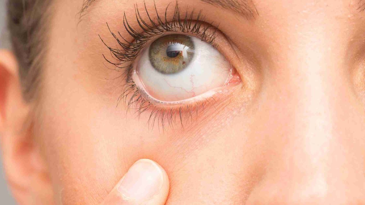 વધુમાં જે લોકો એર-કન્ડિશન્ડ વાતાવરણમાં અથવા ધૂળવાળા, તડકાવાળા અથવા પ્રદૂષિત વાતાવરણમાં ઘણો સમય વિતાવે છે તેઓ પણ આ સમસ્યાથી પીડાય છે. 40 વર્ષથી વધુ ઉંમરના લોકો, કોન્ટેક્ટ લેન્સ પહેરનારાઓ અને સ્ત્રીઓ જે હોર્મોનલ ફેરફારોને કારણે આ સમસ્યાથી વધુ પ્રભાવિત થાય છે.
