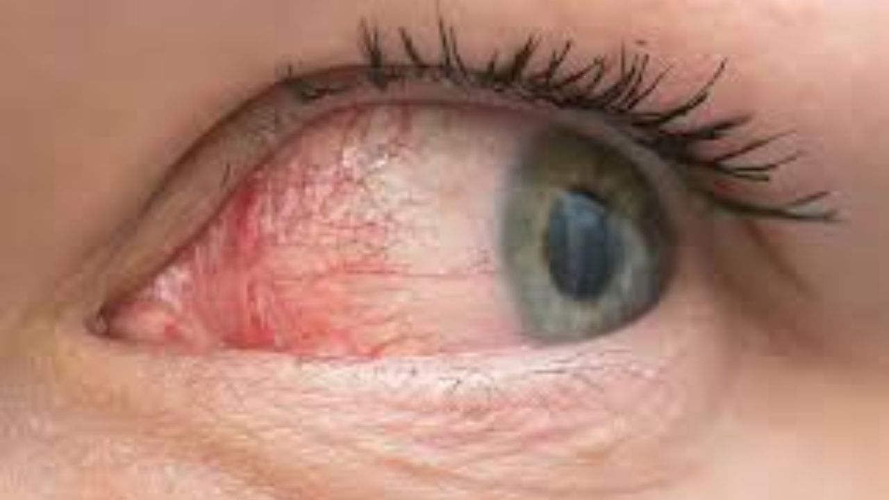 એન્ટિહિસ્ટેમાઈન્સ, બ્લડ પ્રેશરની દવાઓ અથવા ડિપ્રેશનની દવાઓ જેવી કેટલીક દવાઓ પણ આંસુના ઉત્પાદનને અસર કરે છે. ઉંમર સાથે આંસુ ગ્રંથીઓ ઓછી એક્ટિવ રહે છે, જે ડ્રાયનેસને વધારે બનાવે છે. જો આ સમસ્યા લાંબા સમય સુધી ચાલુ રહે છે તો તે કોર્નિયાને નુકસાન પહોંચાડી શકે છે અને દ્રષ્ટિને અસર કરી શકે છે.
