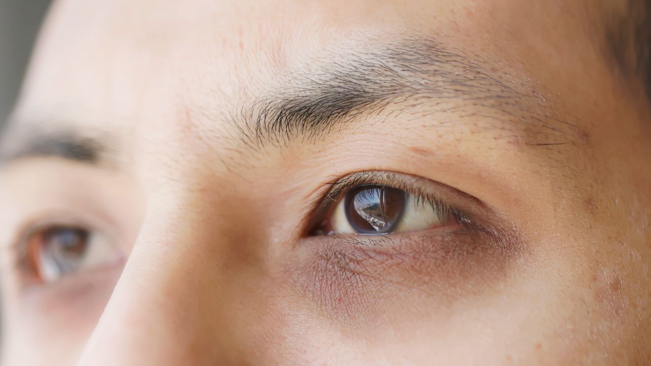 एलर्जी या साइनस की समस्या के कारण भी काले घेरे हो सकते हैं। ऐसे में आपकी आँखों के नीचे की नसों में रक्त के थक्के जम जाते हैं, जिससे काले घेरे हो जाते हैं। राहत पाने के लिए आप भाप या गर्म पानी का इस्तेमाल कर सकते हैं।