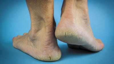 શિયાળામાં પગની એડી ફાટવી એ એક સામાન્ય સમસ્યા છે. તે ડિહાઇડ્રેશન, અયોગ્ય ફૂટવેર અને યોગ્ય કાળજીના અભાવ સહિત વિવિધ પરિબળોને કારણે થઈ શકે છે. આ સમસ્યા સ્ત્રીઓમાં સૌથી સામાન્ય છે.