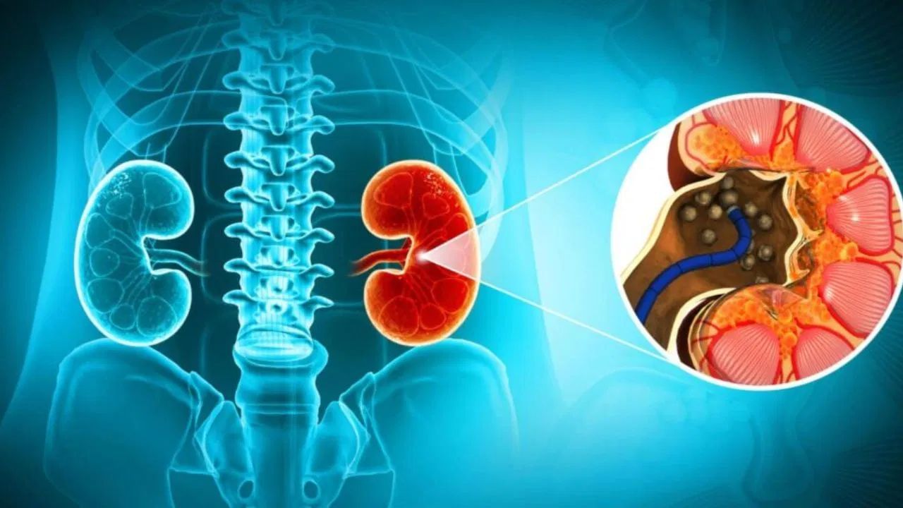 હકીકતમાં, આપણી કિડની શરીરમાંથી ચોક્કસ ખનિજોને ફિલ્ટર કરે છે, જેના માટે પાણીની જરૂર પડે છે. અપૂરતા પાણીના સેવનથી કેલ્શિયમ અને યુરિક એસિડ સ્ફટિકીકરણ થઈ શકે છે, જેના કારણે કિડની પથરીની રચના થાય છે, જેને કિડની સ્ટોન કહેવામાં આવે છે.