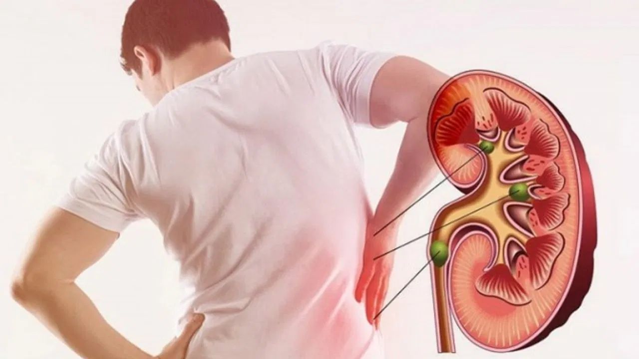 શિયાળામાં કિડની સ્ટોનનું જોખમ કેમ વધારે હોય છે? - શિયાળામાં તાપમાન ઘટતાં, પરસેવો ઓછો થાય છે. આનાથી આપણને ઓછી તરસ લાગે છે, જેના કારણે પાણી ઓછું પીઈ છીએ. જો કે, આપણે ભૂલી જઈએ છીએ કે પાણી ફક્ત તરસ છીપાવવા માટે નથી; આપણી કિડનીને પણ તેની જરૂર હોય છે.