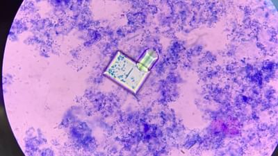  પેશાબમાં થનારી બળતરા મહિલાઓને હંમેશા પરેશાન કરે છે. કેટલીક વખત મહિલાઓ શરમને કારણે આ વિશે ખુલ્લીને વાત કરતી નથી. તો કેટલીક મહિલાઓ આ વાતને નજરઅંદાજ કરે છે પરંતુ શું તમે જાણો છો કો, આની પાછળ ક્યાં કારણો જવાબદાર છે. તેમજ આને નજરઅંદાજ કરવું યોગ્ય છે કે, નહી. 