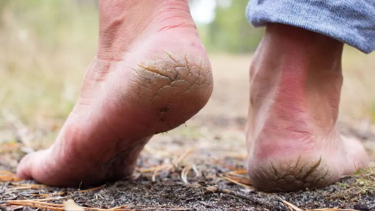  કેટલાક કિસ્સાઓમાં, આ સ્થિતિ એટલી ગંભીર બની શકે છે કે તેમાંથી લોહી નીકળે છે, જેના કારણે ચાલવું મુશ્કેલ બને છે. જો તમે આ સમસ્યાથી પરેશાન છો તો આ ઘરેલું ઉપાયો અજમાવી શકો છો. 