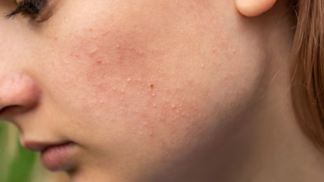 ત્વચાની સમસ્યાઓ - ગોળ ત્વચાની સમસ્યાઓમાં પણ મદદ કરે છે. ગરમ પાણી અને ગોળનું મિશ્રણ આયુર્વેદમાં પણ ફાયદાકારક માનવામાં આવે છે. તેને નિયમિતપણે પીવાથી ખીલ અને ડાઘ ઓછા થાય છે.