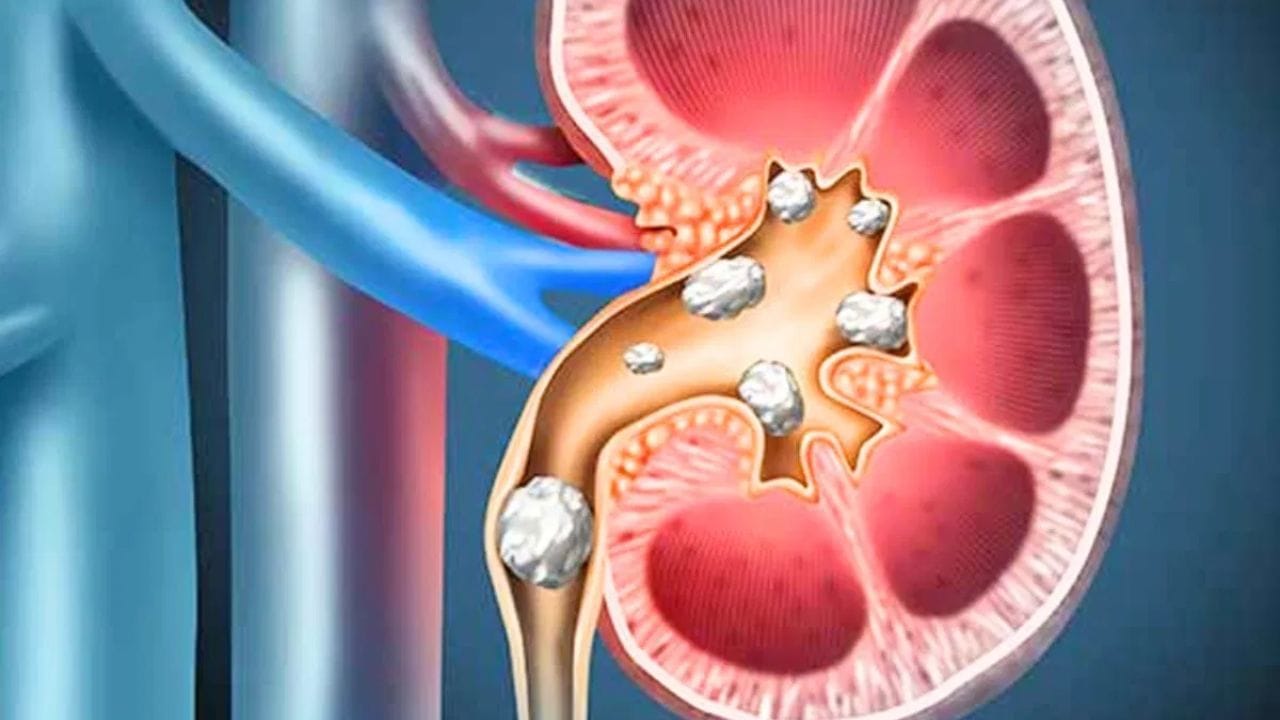 પરંતુ ચિંતા કરવાની કોઈ જરૂર નથી, કારણ કે જીવનશૈલીમાં કેટલાક ફેરફારો કરવાથી કિડનીમાં પથરી થવાની શક્યતા ઓછી રહે છે. ચાલો જાણીએ કે કિડનીમાં પથરી બીજી વાર ના થાય તેના માટે તમારી જીવનશૈલી અને આહારમાં કયા ફેરફારો કરવા જોઈએ.