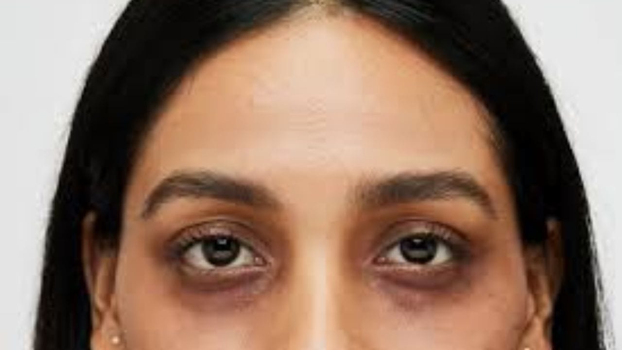 કેટલાક લોકો કહે છે કે મોબાઈલ ફોનના વધુ પડતા ઉપયોગથી ડાર્ક સર્કલ થાય છે, જ્યારે કેટલાક માને છે કે પૂરતી ઊંઘ લેવાથી તે જાતે જ ગાયબ થઈ જશે. કેટલાક ઘરેલું ઉપચાર પર આંધળો વિશ્વાસ કરે છે, જ્યારે કેટલાક મોંઘા ક્રીમ અને સારવારને એકમાત્ર ઈલાજ માને છે. આ આર્ટિકલમાં ચાલો એક નિષ્ણાત સાથે ડાર્ક સર્કલની અફવા પાછળના સત્યની ચર્ચા કરીએ.