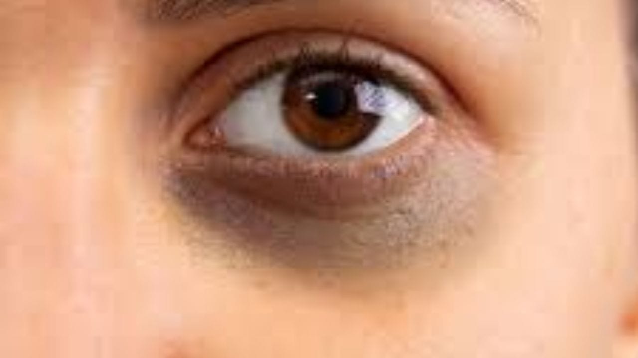 નિષ્ણાતો શું કહે છે?: ડર્મેટોલોજીસ્ટ ડૉ. ઇશિતા પંડિત સમજાવે છે કે લોકોમાં સૌથી મોટી માન્યતા એ છે કે ડાર્ક સર્કલ ઊંઘના અભાવે થાય છે. પરંતુ આવું બિલકુલ નથી. ક્યારેક તે આનુવંશિક હોઈ શકે છે. વધુમાં જો તમારી આંખોની ત્વચા પાતળી હોય અથવા પિગમેન્ટેશન, સાયનોસિસ અથવા એરિથેમા હોય, તો તે જોખમનું પરિબળ હોઈ શકે છે.