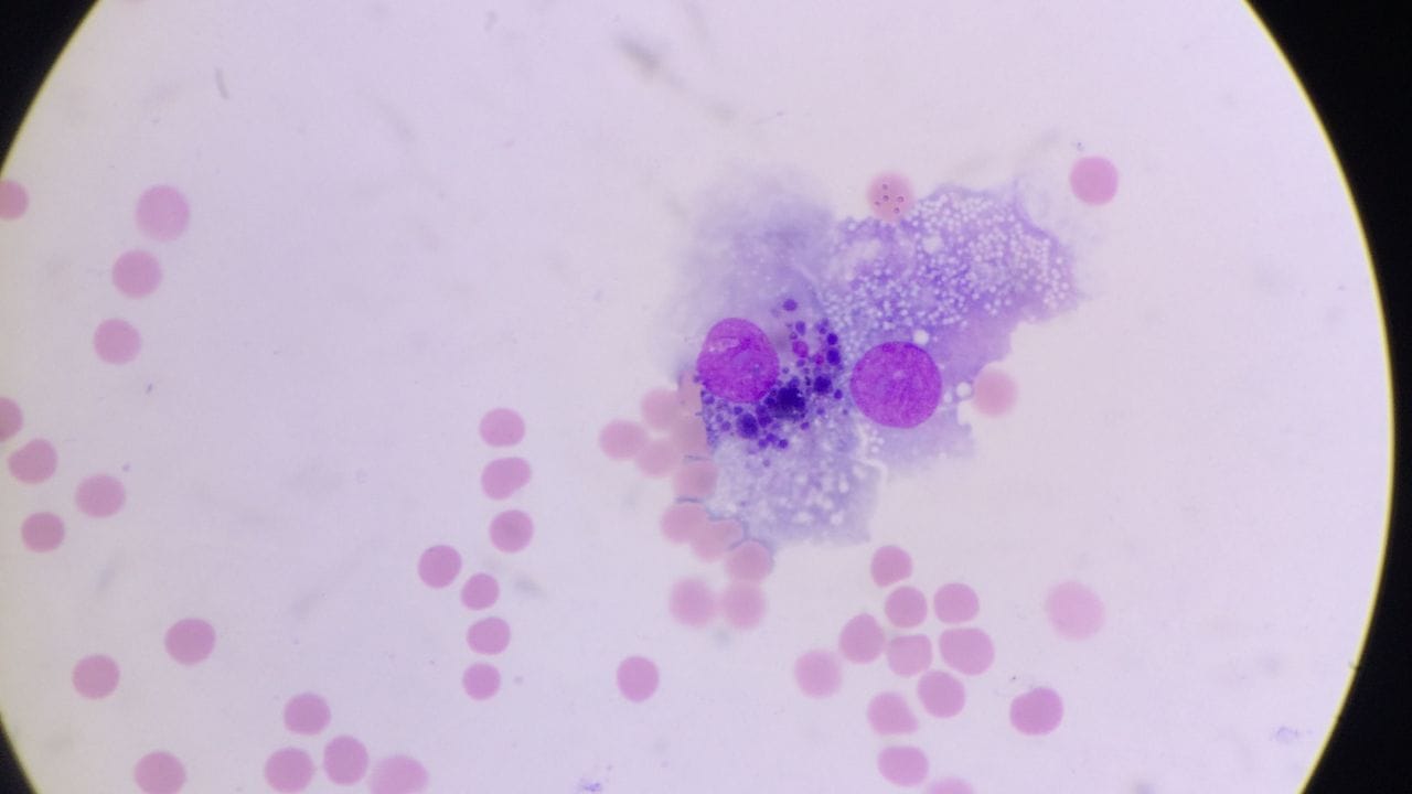 પેપ સ્મીયર ટેસ્ટ કરાવતા પહેલા કઈ વાતનું ધ્યાન રાખવું જોઈએ. પેપ સ્મીયર કરાવવાનો યોગ્ય સમયે પીરિયડ્સ સાઈકલના 10 થી 20 દિવસ વચ્ચે હોય છે. ટેસ્ટ કરાવતા પહેલા 48 કલાક સુધી પિરિયડ્સ દરમિયાન ટેમ્પોન,વજાઈનલ ક્રીમ કે કોઈ પણ પ્રકારના પદાર્થનો ઉપયોગ કરવો જોઈએ નહી.જેનાથી સર્વાઈકલની આસપાસનો વિસ્તાર પ્રભાવિત થાય છે.