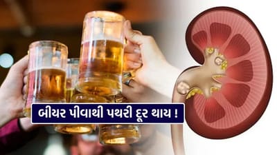 કિડનીની પથરી ઘણા લોકો માટે દુખદાયક સમસ્યા બની રહી છે. સામાન્ય માન્યતા છે કે બીયર પીવાથી કિડનીની પથરી ઓગળી જાય છે. પરંતુ તબીબી દૃષ્ટિએ આ માન્યતા ખોટી છે. હકીકતમાં, બીયરનું સેવન કિડની માટે હાનિકારક પણ થઈ શકે છે.