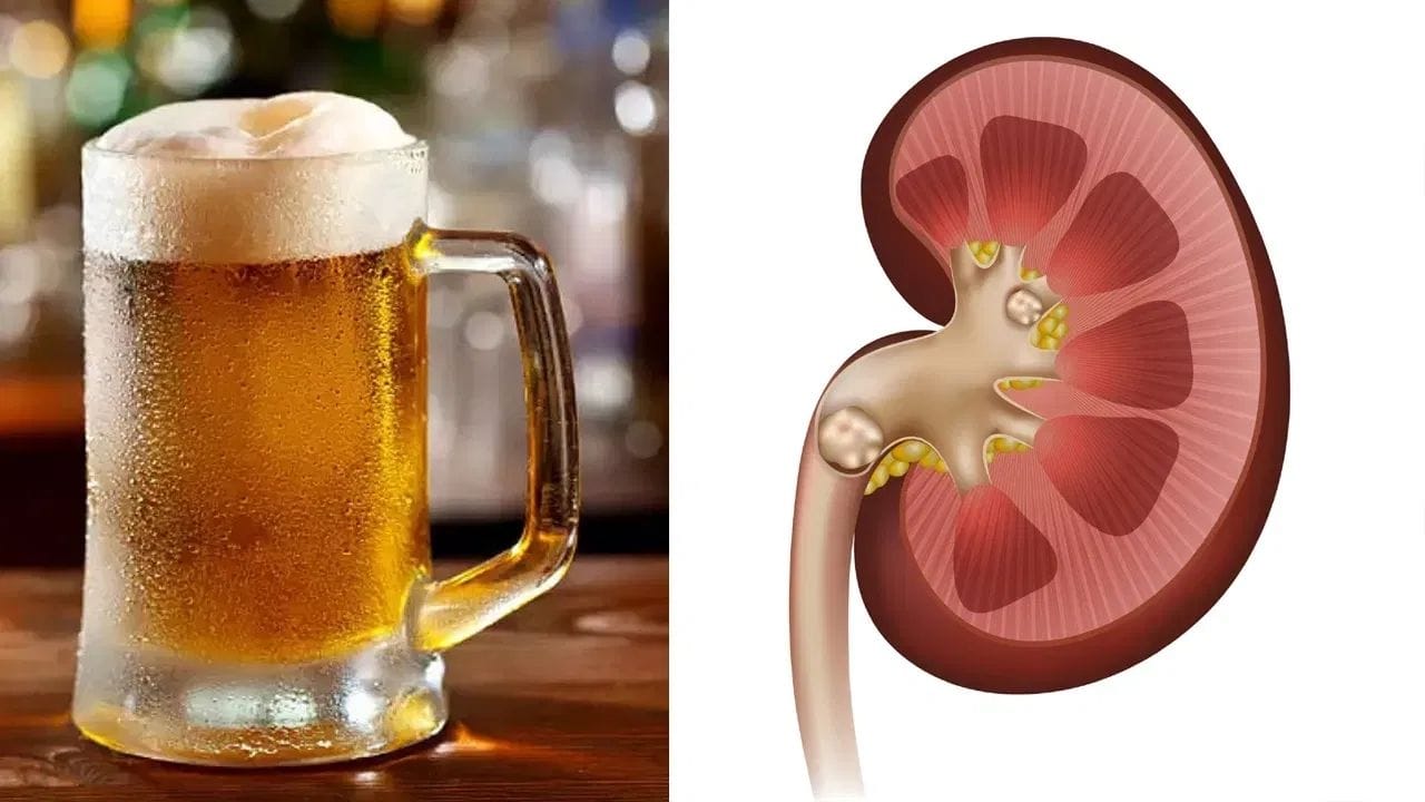 કિડનીના પથ્થરનું કદ પણ મહત્વપૂર્ણ છે. જો પથ્થર 5 મીમી કરતાં મોટો હોય, તો તે સરળતાથી બહાર નીકળી શકતો નથી. બીયર પીવાથી પેશાબનો દબાણ વધે છે, જે પથ્થરને મૂત્રમાર્ગમાં અટકાવી શકે છે અને તીવ્ર પીડા આપી શકે છે.