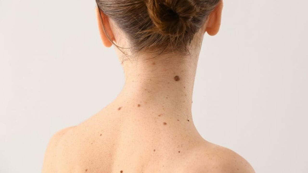 ખાસ કરીને જ્યારે તલ અચાનક દેખાય છે, રંગ બદલે છે અથવા કદમાં વધારો કરે છે, ત્યારે તેને અવગણવું ખતરનાક બની શકે છે. તો ચાલો હવે સમજાવીએ કે શરીર પર ઘણા તલ કેમ દેખાય છે અને તેનું કારણ શું છે.
