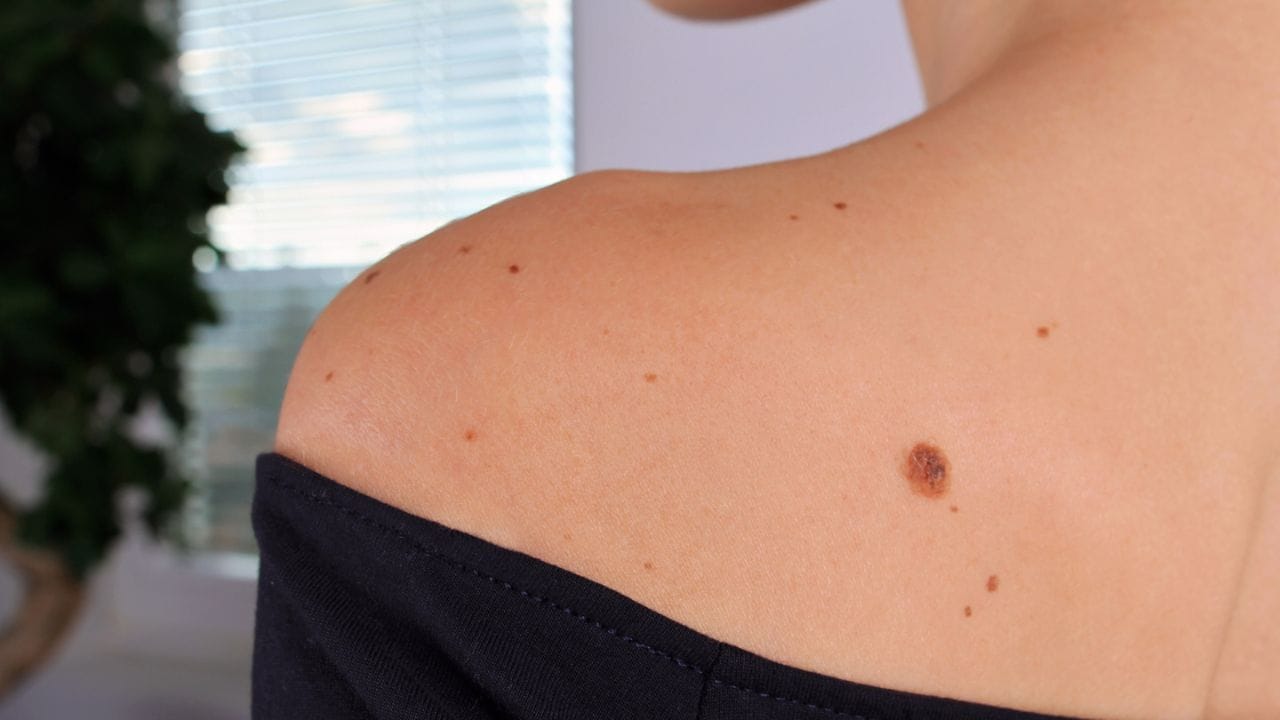 કેટલાક તલ જન્મથી જ હાજર હોય છે. જ્યારે અન્ય ધીમે-ધીમે બાળપણ દરમિયાન દેખાય છે. ત્વચા નિષ્ણાતોના મતે પુખ્ત વયના વ્યક્તિના શરીર પર 10 થી 40 તલ હોવા સામાન્ય માનવામાં આવે છે. આ તલ ઉંમર સાથે થોડા બદલાઈ શકે છે. ઘણા તલ સમય જતાં વધુ સ્પષ્ટ થઈ જાય છે. તેમનો રંગ હળવો થઈ શકે છે અથવા તે જાતે જ અદૃશ્ય થઈ શકે છે.
