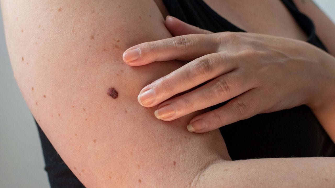 શરીર પર તલ કેમ બને છે?: ડોક્ટરોના મતે શરીર પર તલ બનવા પાછળ ઘણા કારણો હોય છે. જો પરિવારના કોઈ સભ્યમાં ઘણા તલ હોય તો આવનારી પેઢી પણ આ સમસ્યાનો અનુભવ કરી શકે છે. કિશોરાવસ્થા, ગર્ભાવસ્થા અથવા હોર્મોનલ ફેરફારો દરમિયાન નવા તલ દેખાઈ શકે છે. 
