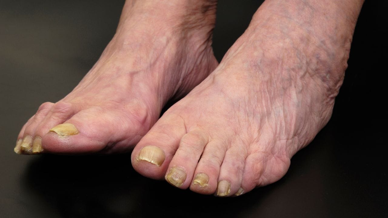 સોજો અને દુખાવો વધે નહીં તે માટે કેટલીક બાબતોનું ધ્યાન રાખવું જરૂરી છે. મીઠાનો ઉપયોગ ઓછો કરો, પૂરતું પાણી પીવો અને ઠંડીના વધુ સંપર્કથી બચો. હાથ અને પગ હંમેશા ગરમ રાખવા મોજા પહેરો. હળવી કસરત, ખેંચાણ અને ચાલવાની ટેવ રાખો. આંગળીઓને સીધા સૂર્યપ્રકાશમાં રાખવાનું ટાળો. જો સોજો લાંબા સમય સુધી રહે અથવા વધે, તો તાત્કાલિક ડૉક્ટરની સલાહ લેવી જોઈએ.(નોંધ : અહીં આપવામાં આવેલી માહિતી ફકત આપની જાણકારી માટે છે.)