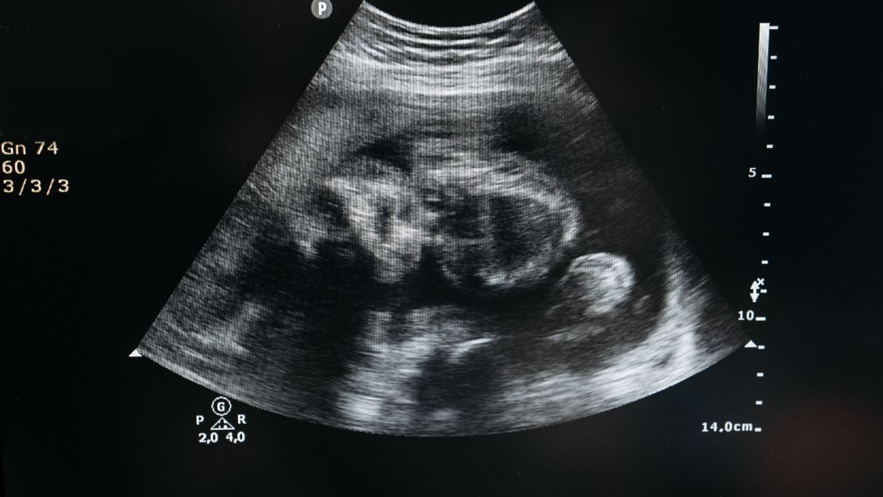 પેલ્વિક ઈન્ફ્લેમેટરી રોગ એક ગંભીર સંક્રમણ છે. જે મહિલાના પ્રાઈવેટ પાર્ટ કે ખાસ કરીને ફૈલોપિયન ટ્યુબમાં ફેલાય શકે છે. આ ગોનોરિયા કે ક્લૈમાઈડિયા જેમ કે યૌન સંચારિત રોગના કારણે થાય છે. આનાથી ફૈલોપિયન ટ્યુબમાં સોજો આવી જાય છે. ત્યારબાદ એક્ટોપિક પ્રેગ્નન્સીનું કારણ બની જાય છે.