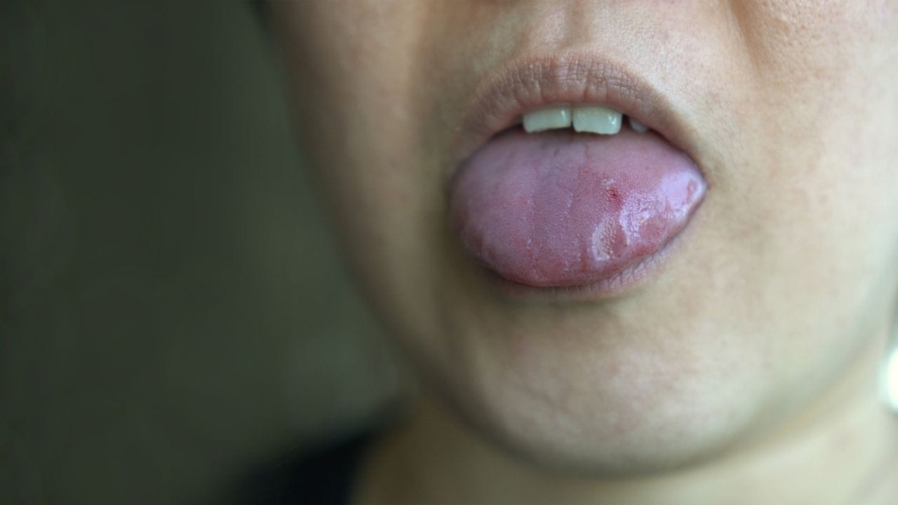 જો ગરમ પીણાંથી જીભ બળી જાય, તો તરત જ ઠંડક આપવી જરૂરી છે. જોકે, જીભ પર સીધો બરફ લગાવવો ટાળવો જોઈએ. તેના બદલે થોડા સમય માટે મોઢામાં ઠંડુ પાણી રાખો અને પછી ધીમે ધીમે કોગળા કરો. આ પ્રક્રિયા બે થી ત્રણ વાર કરવાથી બળતરામાં રાહત મળે છે.